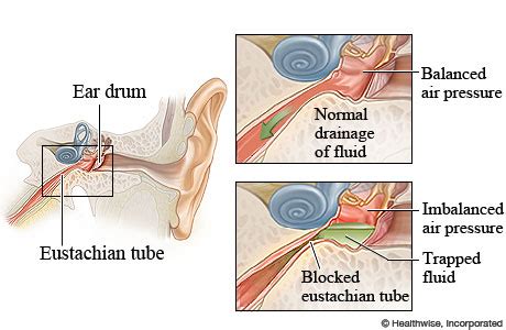 Eustachian tube dysfunction (blocked ears) .